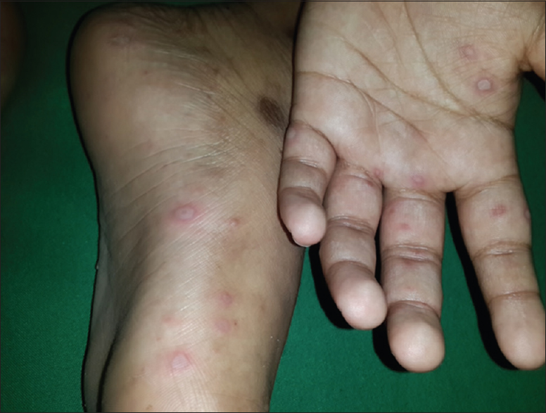 Hand, Foot and Mouth Disease